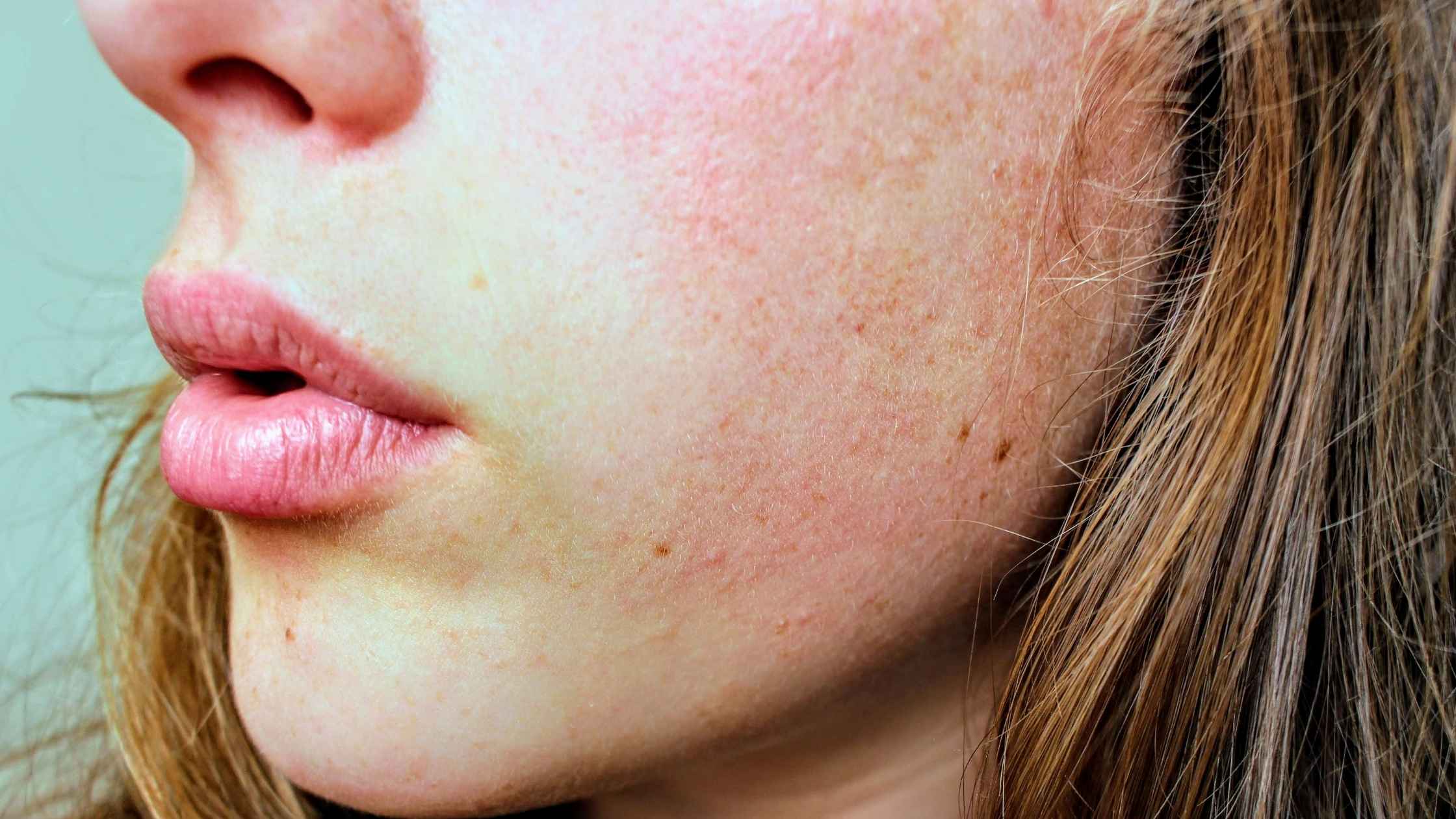 Rosacea-Rötungen verstehen: Welche Rolle dabei dein Stoffwechsel spielt. Aktuelle Studienlage über den Zusammenhang zwischen dem Stoffwechsel und Rosacea von Claudia Rönsch, die Glückstrainerin, ganzheitliche Gesundheits- & Ernährungsberaterin, Hamburg